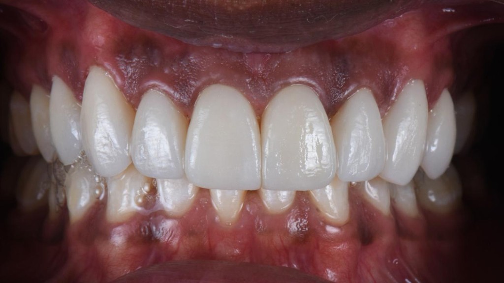 After — porcelain veneers