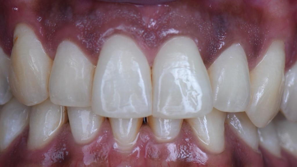 Before — porcelain veneers