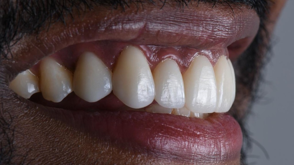 Side view — porcelain veneers final result